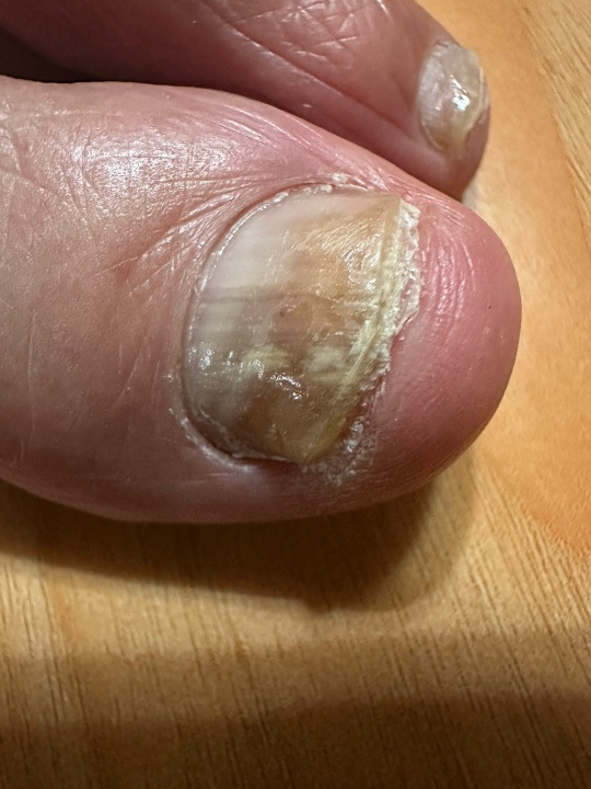 발톱무좀, 어떻게 치료해야 할까요? (병원 치료법)