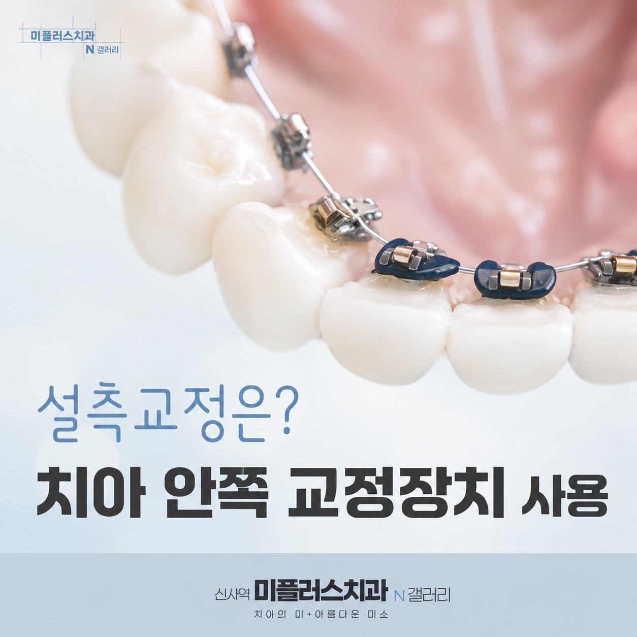 설측교정 치아 안쪽 교정장치 모습, 티 나지 않는 치아교정 방법 안내 이미지