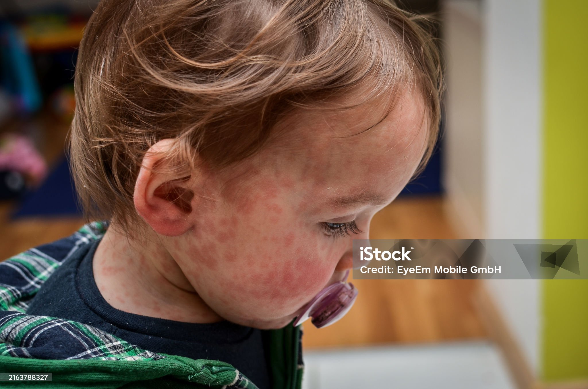 홍역-관련-사진