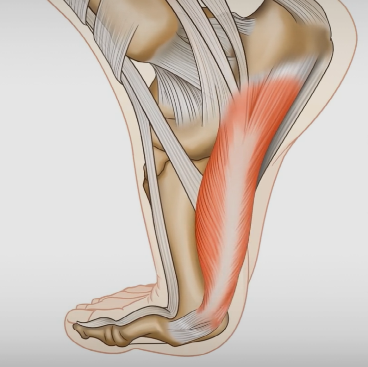 족저 근막염 자가치료