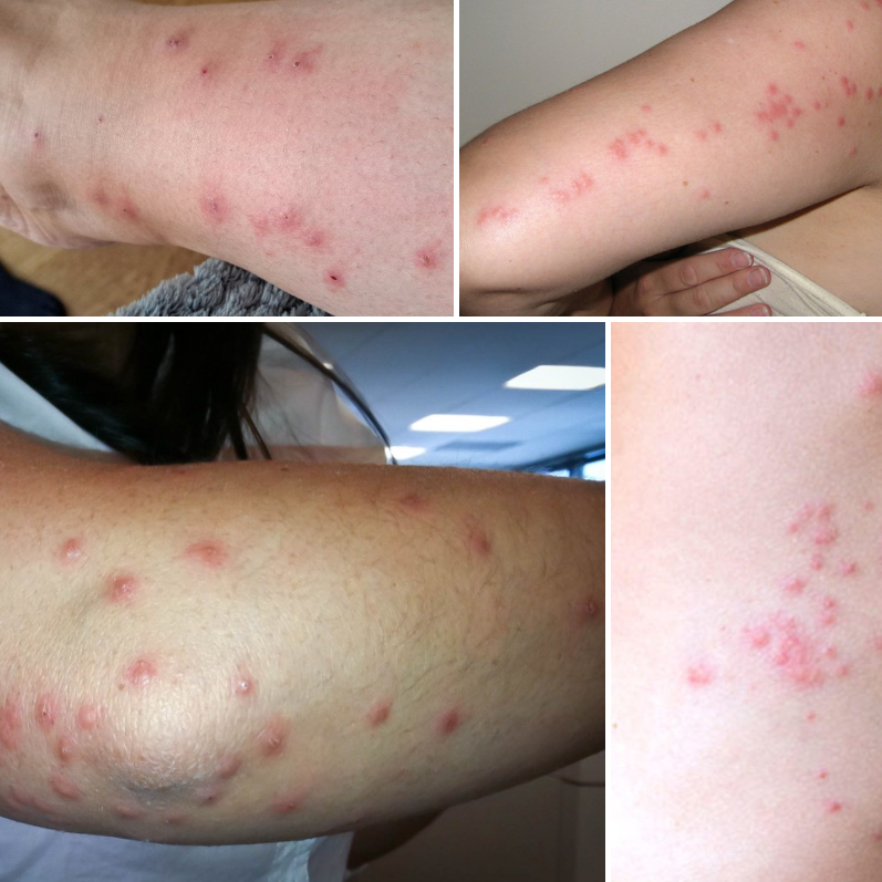 빈대 물린자국 : 빈대 퇴치법&amp;#44; 증상&amp;#44; 예방법