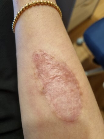 전기-장판에-다리를-2도-화상으로-데인-모습-조심하세요