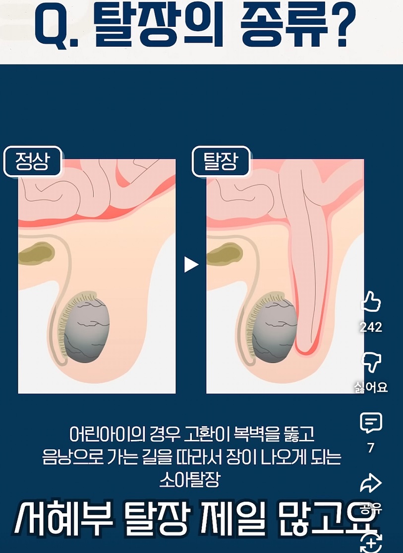 EBS-명의-탈장-명의-하태경-교수