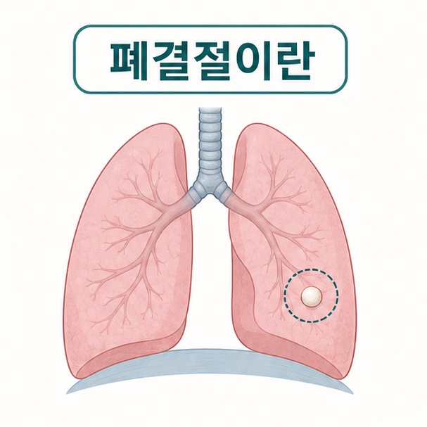 폐 안에 작은 원형 병변이 표시되어 폐결절의 기본 개념을 설명하는 그림