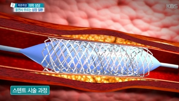 EBS명의-심혈관명의-김병극-교수