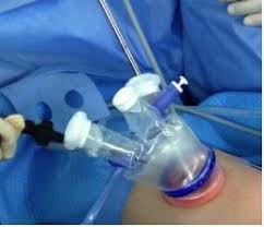 맹장의 위치과 증상