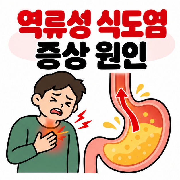 위와 식도 사이로 위산이 올라오는 단순 그림 옆에 역류성 식도염 증상 원인 문구를 크게 보여주는 대표 카드
