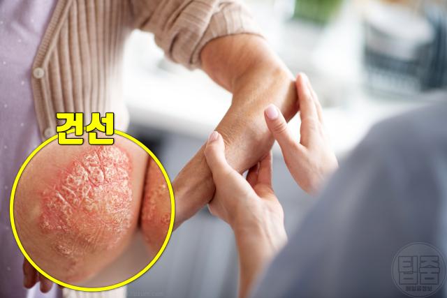 팔꿈치 피부 두껍고 딱딱