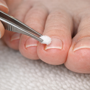 내성발톱 안생기는법(교정 및 치료 방법) 완벽 가이드 2026