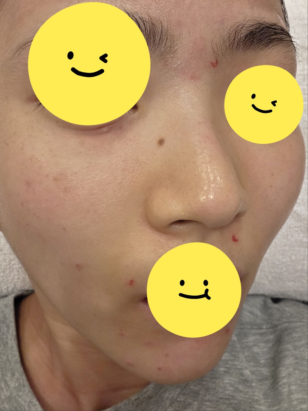 여드름 압출 직후 얼굴에 붉은 자국과 피가 보이는 상태