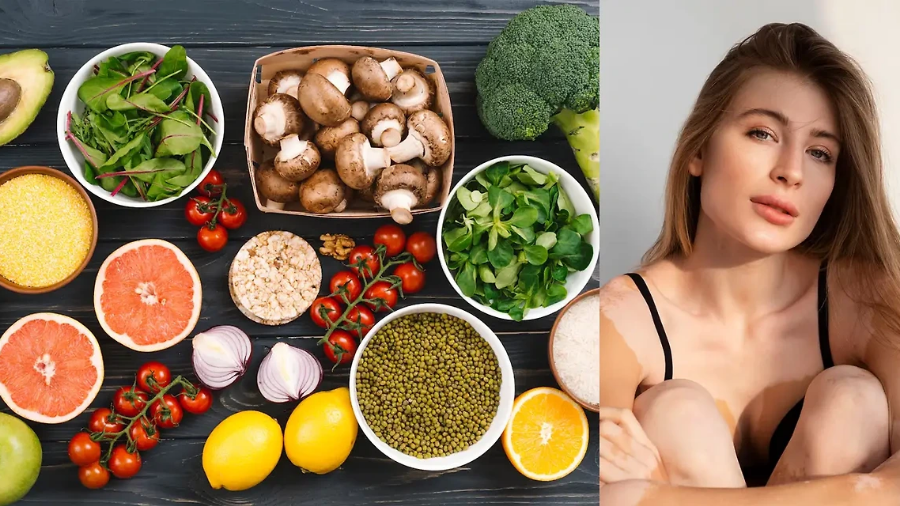 백반증 완벽 가이드