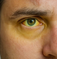 간수치가 올라가는 이유와 간수치 내리는 방법