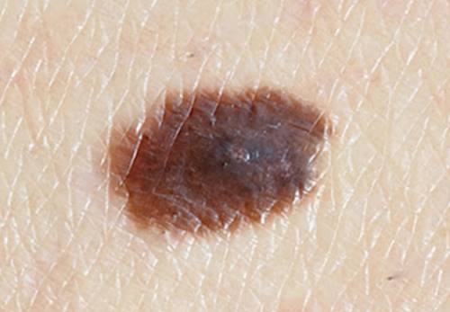 검버섯 제거 비용