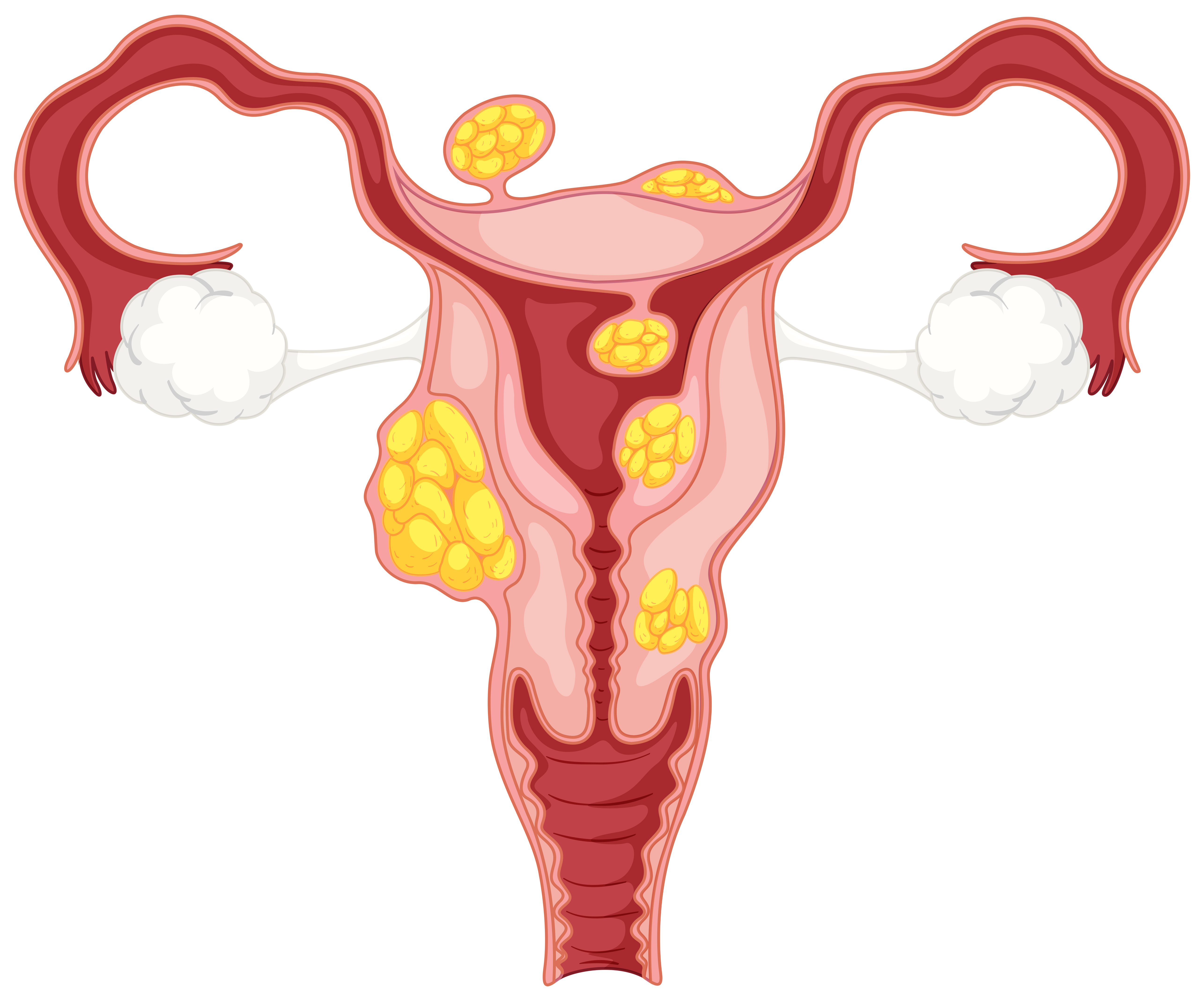 diagram-subserosal-uterine-fibroids-isolated