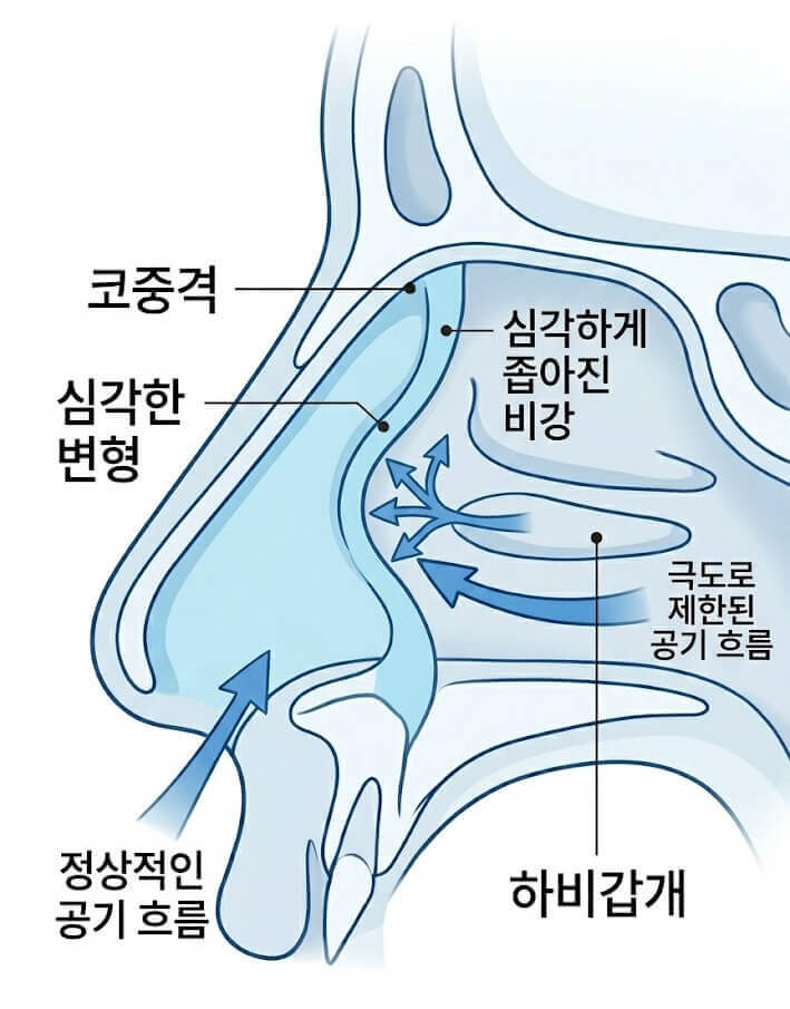 비중격만곡증과 관련된 인포그래픽