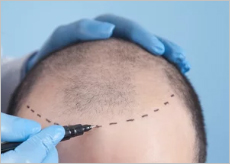 탈모로 고민하는 남성과 모발이식을 위해 머리에 디자인을 하는 이미지