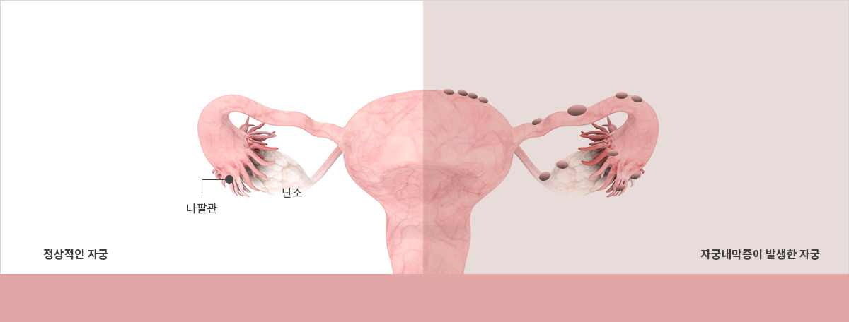 여자 왼쪽 아랫배 통증 원인 7가지 왼쪽 아랫배 땡김 콕콕 찌릿 증상