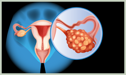 난소암 3기 4기 치료 방법