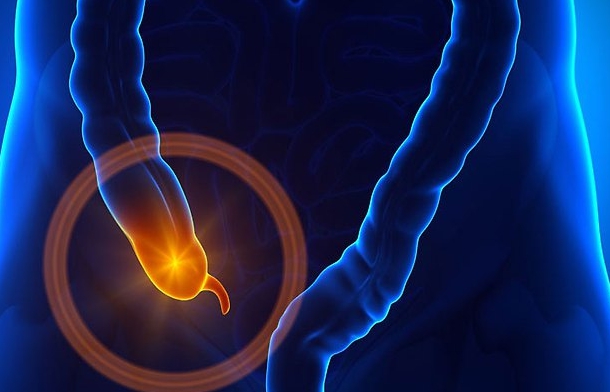 탈장(서혜부 탈장)