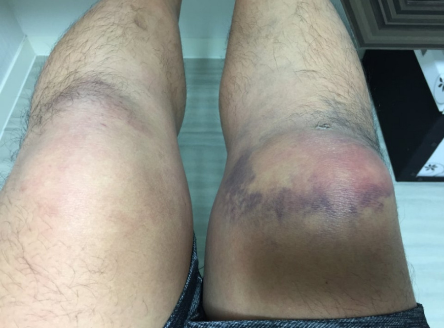 양쪽 무릎에 타박상으로 인해서 시꺼먼 피멍과 외상 그리고 붓기가 있는 것을 찍은 사진