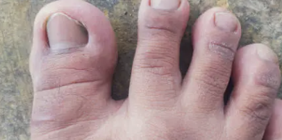 발가락 통증