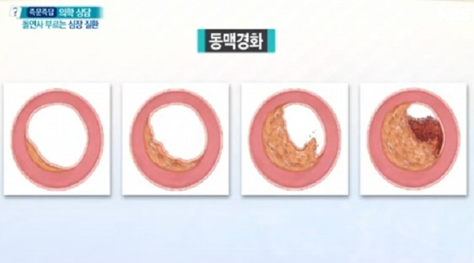 동맥경화