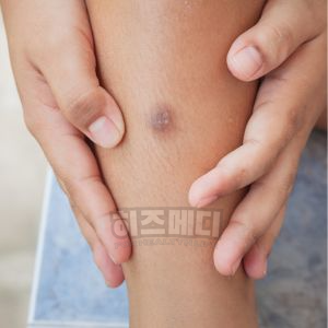 쯔쯔가무시 물린자국