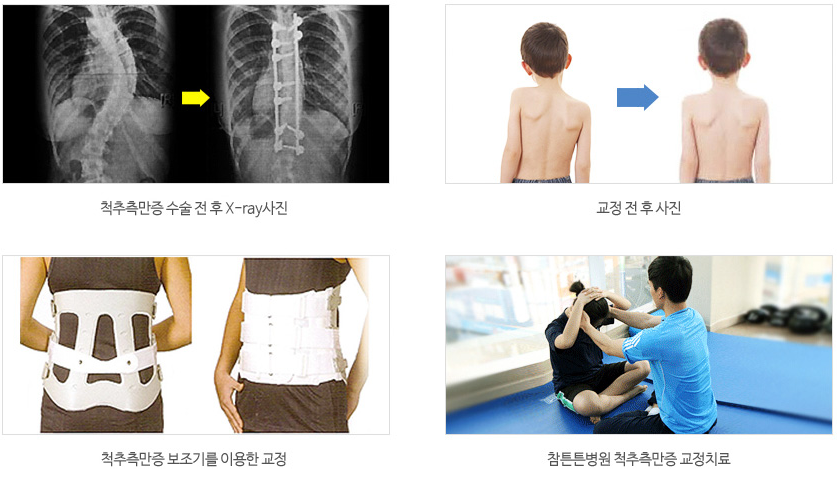 척추측만증과 함께하는 삶, 척추측만증에 대해 알아보자