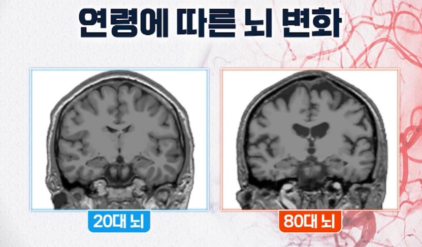 치매 건망증 차이