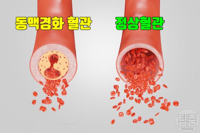 동맥경화 초기증상