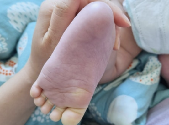 돌아기 청색증, 알아두면 우리 아이 지킬 수 있어요