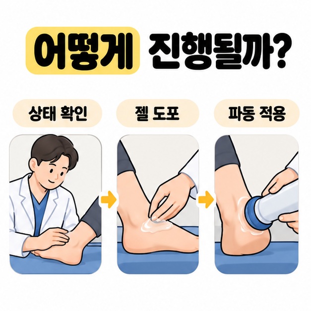 발뒤꿈치 상태 확인과 젤 도포, 파동 적용으로 이어지는 체외충격파 치료 과정을 보여주는 이미지
