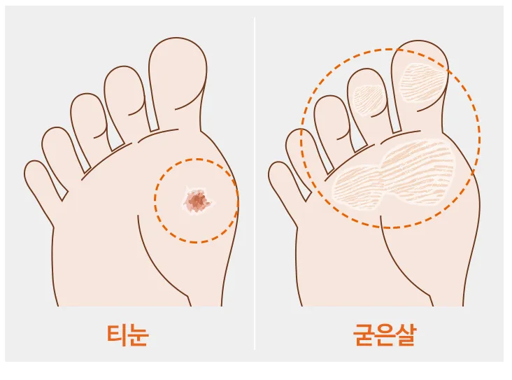 티눈과-굳은살-비교그림