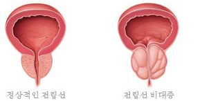 전립선 PSA 정상수치