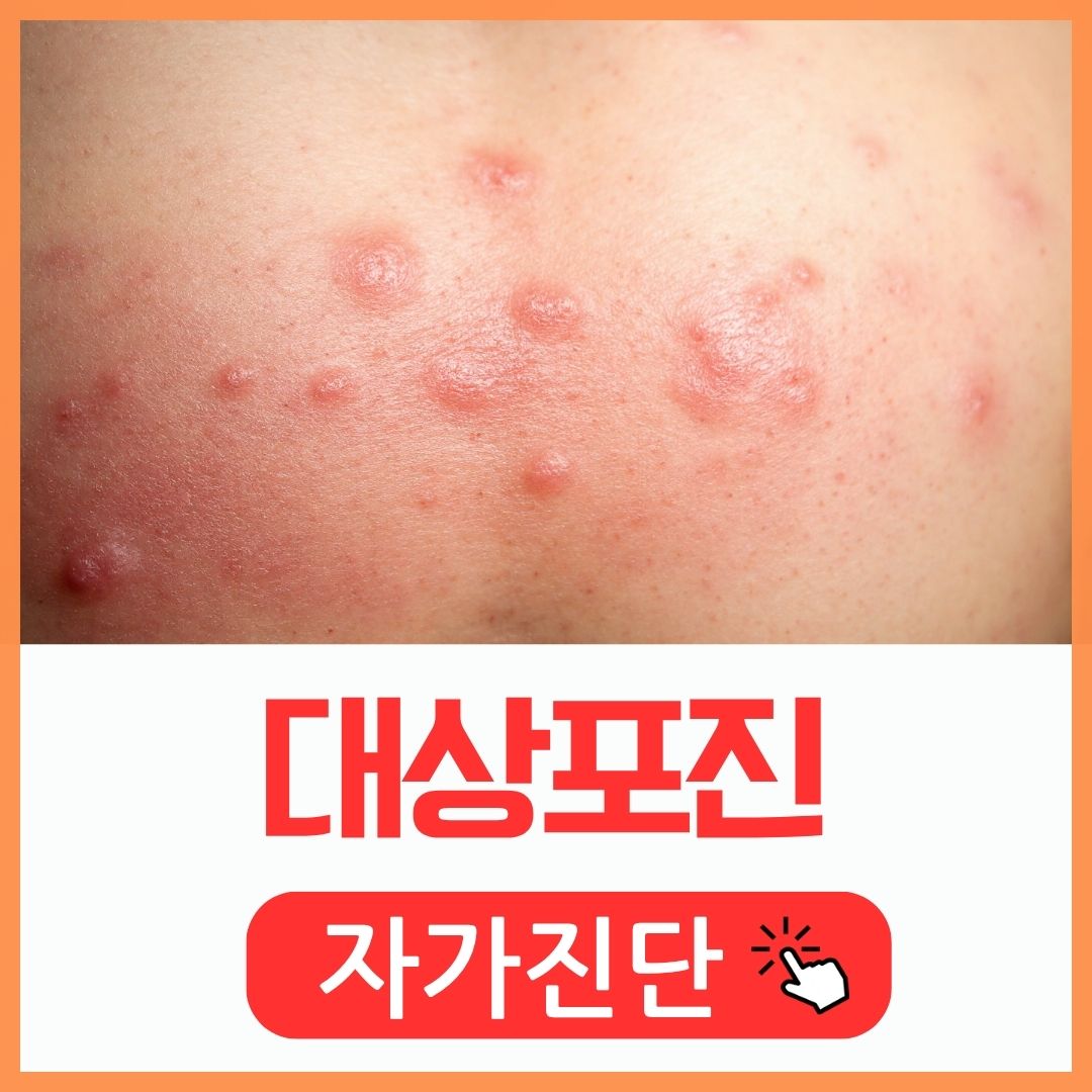 대상포진 증상 및 자가진단_썸네일