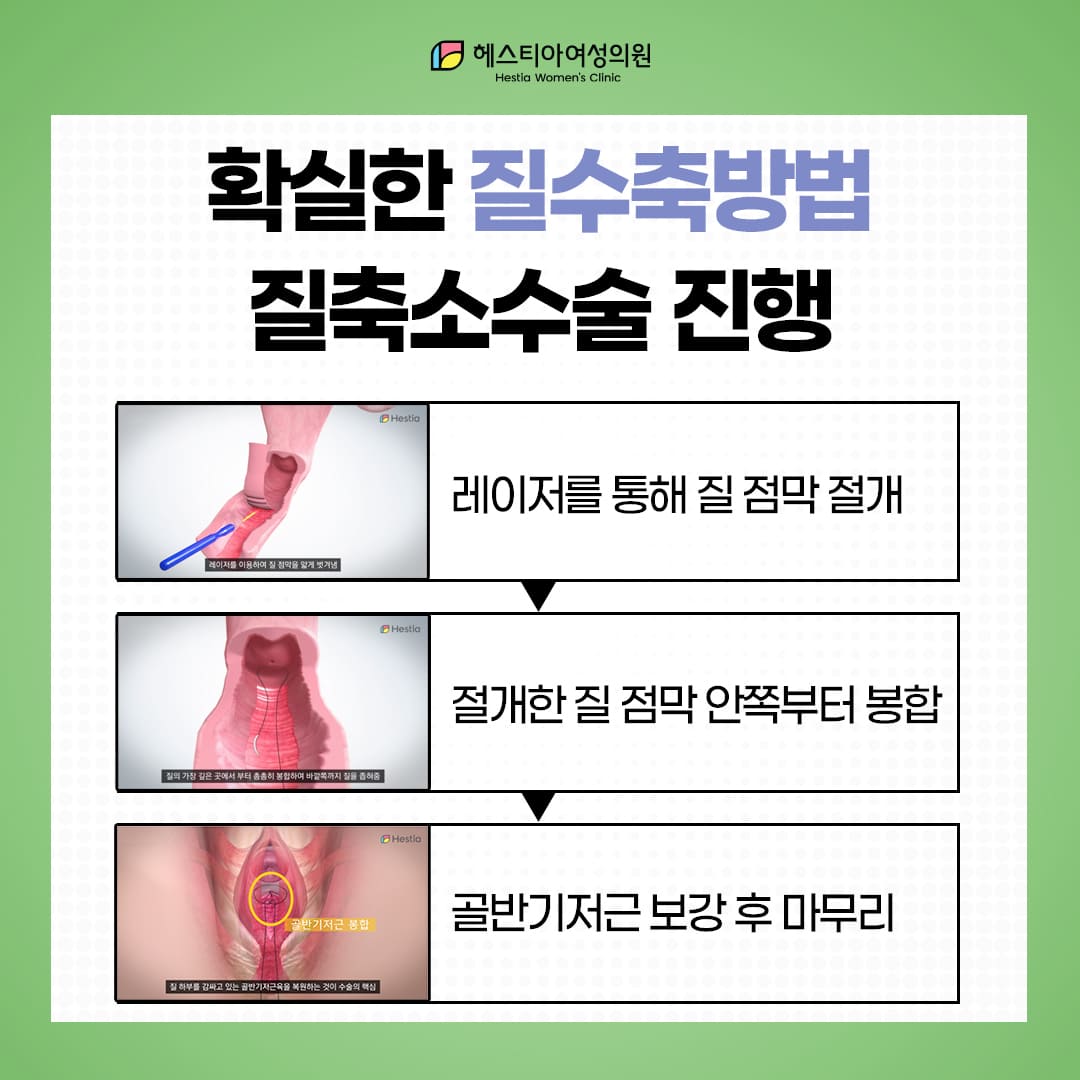 이쁜이수술은 어떻게 진행될까?