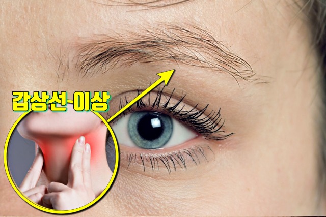 눈썹 빠짐,갑상선기능저하증,생로병사의비밀