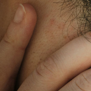 이명 치료 지압법