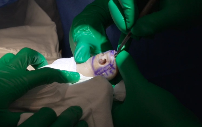 명의 피부암 점 구별법