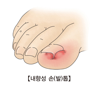 내향성 손발톱
