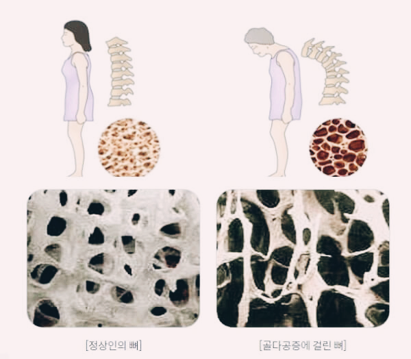 정상적인 뼈와 골다공증 뼈
