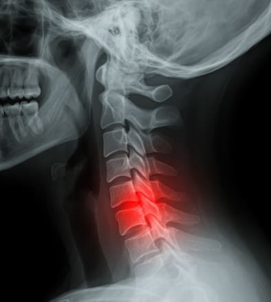 목디스크 증상과 치료방법