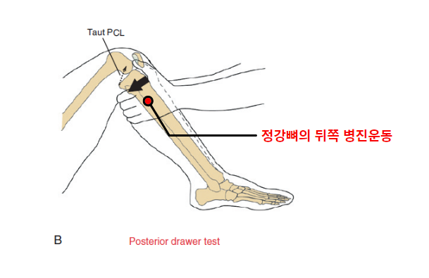 뒤끌림 검사