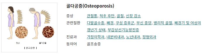 골다공증(출처 서울아산병원)