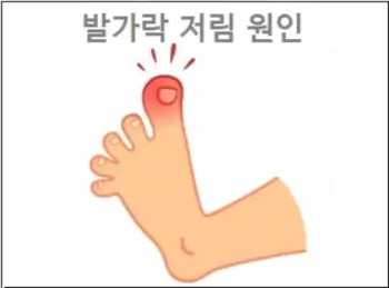 발가락 저림 원인