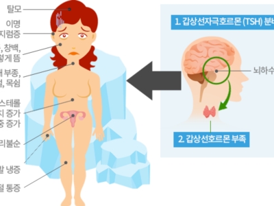 갑상선 이미지
