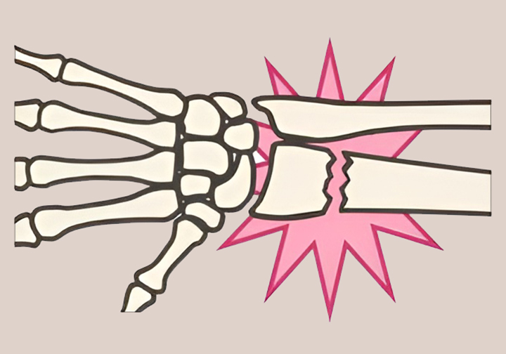 골절된-손목-모습