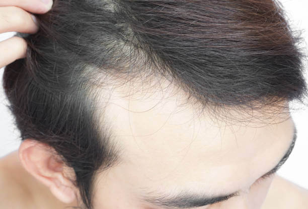 미녹시딜 여자 남자 효능, 탈모치료제 미녹시딜은 지난 몇년간 대세가 되어 온 탈모치료제 중 하나입니다. 미녹시딜은 남성형 탈모와 여성형 탈모 모두에게 효과가 있으며, 외용제 형태로 발매되고 있습니다. 이 글에서는 미녹시딜의 작용 메커니즘, 사용법, 주의사항 등을 자세하게 알아보도록 합니다.