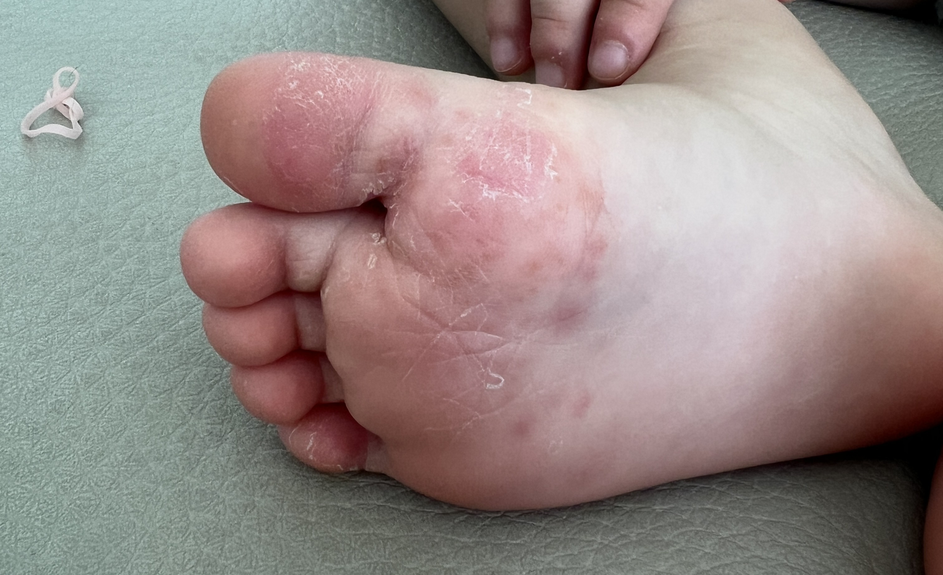 아이 발바닥 발진과 습진