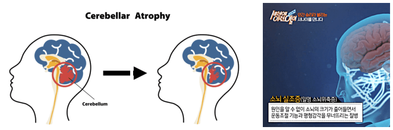 소뇌위축증 사진 3개